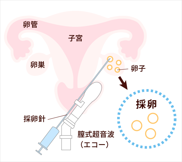 採卵手術