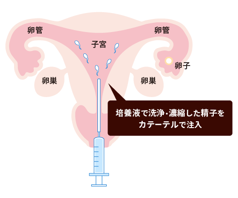 人工授精