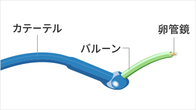 カテーテル、バルーン、卵管鏡