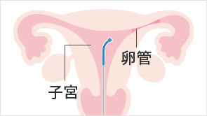 カテーテルを子宮へ挿入