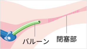 バルーンを加圧し、拡張する