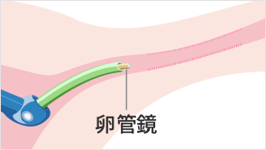 卵管の状態を確認