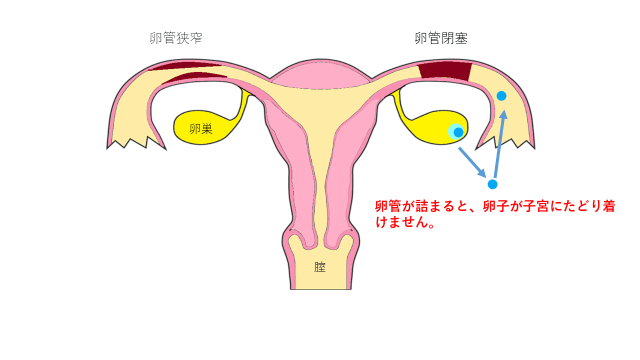 卵管性不妊とクラミジア感染症 不妊治療クリニックスタッフブログ｜桜十字渋谷バースクリニック