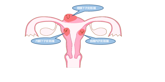 子宮筋腫