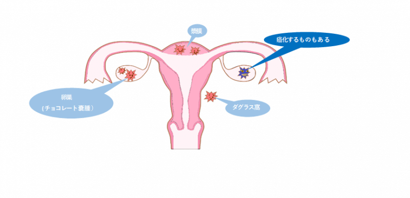 子宮内膜症（チョコレート嚢胞） 不妊治療クリニックスタッフブログ｜桜十字渋谷バースクリニック