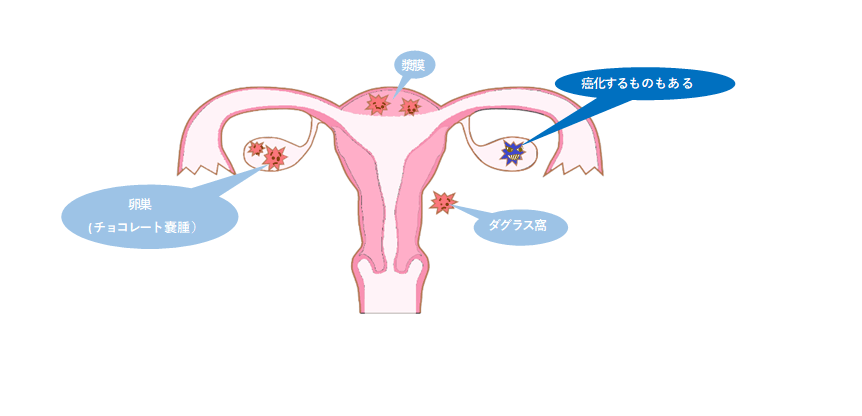 子宮内膜症とPCOSを理解する