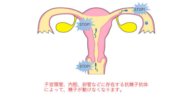 抗精子抗体とフーナーテスト スタッフブログ｜桜十字渋谷バースクリニック