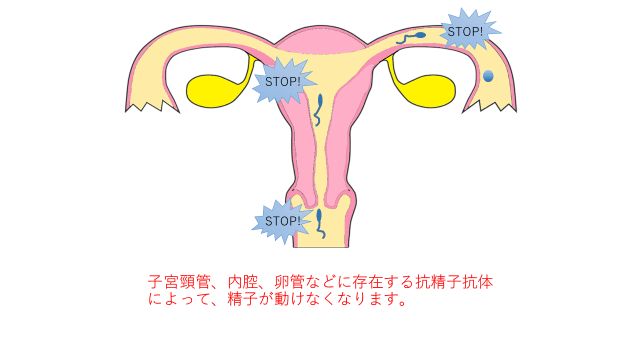 抗精子抗体